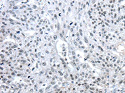 The image on the left is immunohistochemistry of paraffin-embedded Human breast cancer tissue using CSB-PA104649(TRIM33 Antibody) at dilution 1/25, on the right is treated with synthetic peptide. (Original magnification: ×200)