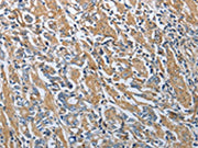 The image on the left is immunohistochemistry of paraffin-embedded Human gastic cancer tissue using CSB-PA104672(RETN Antibody) at dilution 1/20, on the right is treated with fusion protein. (Original magnification: ×200)