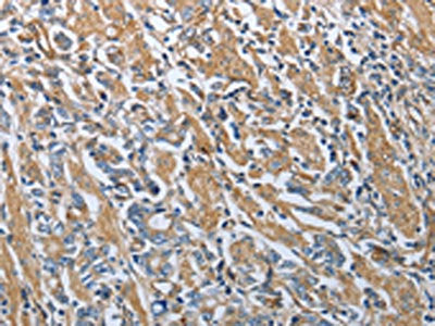 The image on the left is immunohistochemistry of paraffin-embedded Human gastic cancer tissue using CSB-PA104672(RETN Antibody) at dilution 1/20, on the right is treated with fusion protein. (Original magnification: ×200)