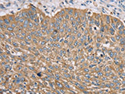 The image on the left is immunohistochemistry of paraffin-embedded Human lung cancer tissue using CSB-PA104885(TFRC Antibody) at dilution 1/35, on the right is treated with synthetic peptide. (Original magnification: ×200)