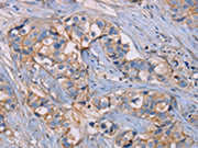 The image on the left is immunohistochemistry of paraffin-embedded Human breast cancer tissue using CSB-PA104968(GHITM Antibody) at dilution 1/30, on the right is treated with fusion protein. (Original magnification: ×200)
