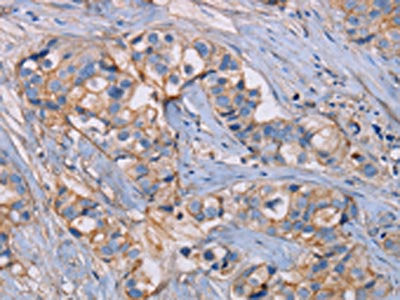 The image on the left is immunohistochemistry of paraffin-embedded Human breast cancer tissue using CSB-PA104968(GHITM Antibody) at dilution 1/30, on the right is treated with fusion protein. (Original magnification: ×200)