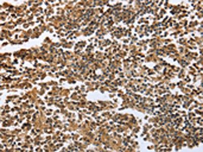 The image on the left is immunohistochemistry of paraffin-embedded Human tonsil tissue using CSB-PA105007(ECE1 Antibody) at dilution 1/60, on the right is treated with fusion protein. (Original magnification: ×200)