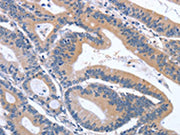 The image on the left is immunohistochemistry of paraffin-embedded Human colon cancer tissue using CSB-PA105485(GDF11 Antibody) at dilution 1/30, on the right is treated with synthetic peptide. (Original magnification: ×200)