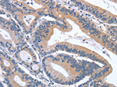 The image on the left is immunohistochemistry of paraffin-embedded Human colon cancer tissue using CSB-PA105485(GDF11 Antibody) at dilution 1/30, on the right is treated with synthetic peptide. (Original magnification: ×200)