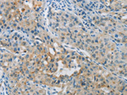 The image on the left is immunohistochemistry of paraffin-embedded Human lung cancer tissue using CSB-PA105506(PRKCA Antibody) at dilution 1/30, on the right is treated with synthetic peptide. (Original magnification: ×200)