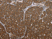 The image on the left is immunohistochemistry of paraffin-embedded Human ovarian cancer tissue using CSB-PA105517(FOLH1B Antibody) at dilution 1/30, on the right is treated with synthetic peptide. (Original magnification: ×200)
