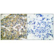 Immunohistochemical analysis of paraffin-embedded human breast carcinoma tissue using FHIT antibody.