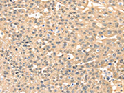 The image on the left is immunohistochemistry of paraffin-embedded Human ovarian cancer tissue using CSB-PA105671(MAP2K3 Antibody) at dilution 1/10, on the right is treated with fusion protein. (Original magnification: ×200)