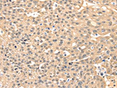 The image on the left is immunohistochemistry of paraffin-embedded Human ovarian cancer tissue using CSB-PA105671(MAP2K3 Antibody) at dilution 1/10, on the right is treated with fusion protein. (Original magnification: ×200)