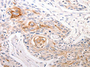 The image on the left is immunohistochemistry of paraffin-embedded Human esophagus cancer tissue using CSB-PA105805(DFFB Antibody) at dilution 1/30, on the right is treated with synthetic peptide. (Original magnification: ×200)
