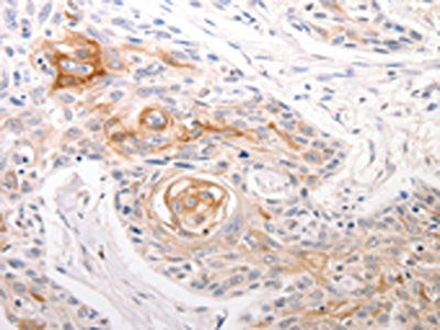 The image on the left is immunohistochemistry of paraffin-embedded Human esophagus cancer tissue using CSB-PA105805(DFFB Antibody) at dilution 1/30, on the right is treated with synthetic peptide. (Original magnification: ×200)