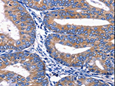 The image on the left is immunohistochemistry of paraffin-embedded Human cervical cancer tissue using CSB-PA105837(PLEKHO1 Antibody) at dilution 1/20, on the right is treated with synthetic peptide. (Original magnification: ×200)