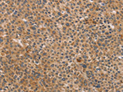 The image on the left is immunohistochemistry of paraffin-embedded Human liver cancer tissue using CSB-PA105838(CDK11A/CDK11B Antibody) at dilution 1/40, on the right is treated with synthetic peptide. (Original magnification: ×200)