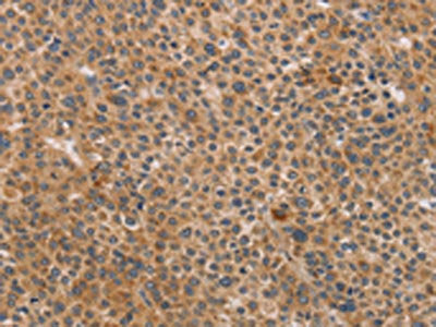 The image on the left is immunohistochemistry of paraffin-embedded Human liver cancer tissue using CSB-PA105838(CDK11A/CDK11B Antibody) at dilution 1/40, on the right is treated with synthetic peptide. (Original magnification: ×200)