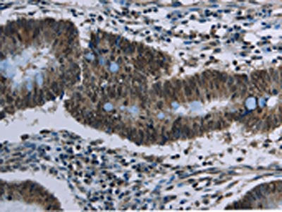The image on the left is immunohistochemistry of paraffin-embedded Human colon cancer tissue using CSB-PA105996(CFLAR Antibody) at dilution 1/20, on the right is treated with synthetic peptide. (Original magnification: ×200)