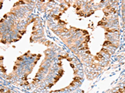 The image on the left is immunohistochemistry of paraffin-embedded Human cervical cancer tissue using CSB-PA106123(DNMT1 Antibody) at dilution 1/35, on the right is treated with synthetic peptide. (Original magnification: ×200)