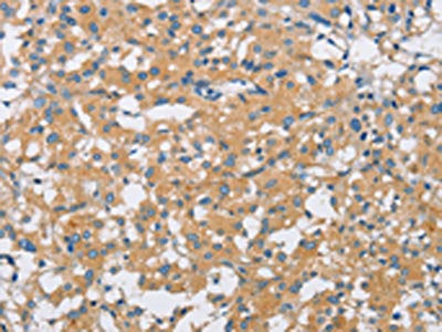 The image on the left is immunohistochemistry of paraffin-embedded Human thyroid cancer tissue using CSB-PA106166(SH3GLB1 Antibody) at dilution 1/25, on the right is treated with fusion protein. (Original magnification: ×200)