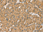 The image on the left is immunohistochemistry of paraffin-embedded Human liver cancer tissue using CSB-PA106236(SEC14L2 Antibody) at dilution 1/40, on the right is treated with synthetic peptide. (Original magnification: ×200)