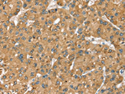 The image on the left is immunohistochemistry of paraffin-embedded Human liver cancer tissue using CSB-PA106236(SEC14L2 Antibody) at dilution 1/40, on the right is treated with synthetic peptide. (Original magnification: ×200)