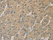 The image on the left is immunohistochemistry of paraffin-embedded Human liver cancer tissue using CSB-PA106326(CYP2C9 Antibody) at dilution 1/50, on the right is treated with fusion protein. (Original magnification: ×200)