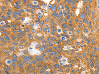 The image on the left is immunohistochemistry of paraffin-embedded Human ovarian cancer tissue using CSB-PA106379(MYOD1 Antibody) at dilution 1/120, on the right is treated with synthetic peptide. (Original magnification: ×200)