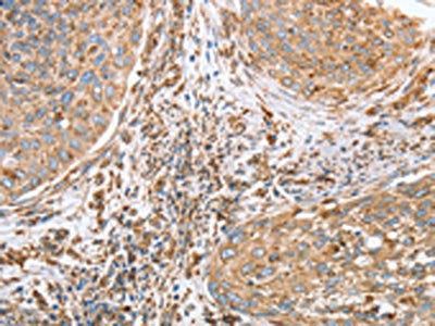 The image on the left is immunohistochemistry of paraffin-embedded Human cervical cancer tissue using CSB-PA106469(CANX Antibody) at dilution 1/40, on the right is treated with fusion protein. (Original magnification: ×200)