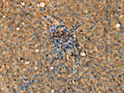 The image on the left is immunohistochemistry of paraffin-embedded Human cervical cancer tissue using CSB-PA106602(ADCY3 Antibody) at dilution 1/30, on the right is treated with fusion protein. (Original magnification: ×200)