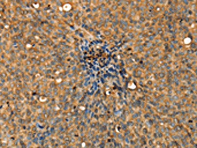 The image on the left is immunohistochemistry of paraffin-embedded Human cervical cancer tissue using CSB-PA106602(ADCY3 Antibody) at dilution 1/30, on the right is treated with fusion protein. (Original magnification: ×200)