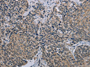 The image on the left is immunohistochemistry of paraffin-embedded Human cervical cancer tissue using CSB-PA106910(MARVELD1 Antibody) at dilution 1/40, on the right is treated with synthetic peptide. (Original magnification: ×200)