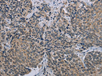 The image on the left is immunohistochemistry of paraffin-embedded Human cervical cancer tissue using CSB-PA106910(MARVELD1 Antibody) at dilution 1/40, on the right is treated with synthetic peptide. (Original magnification: ×200)
