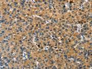 The image on the left is immunohistochemistry of paraffin-embedded Human liver cancer tissue using CSB-PA106951(GNB2L1 Antibody) at dilution 1/20, on the right is treated with fusion protein. (Original magnification: ×200)