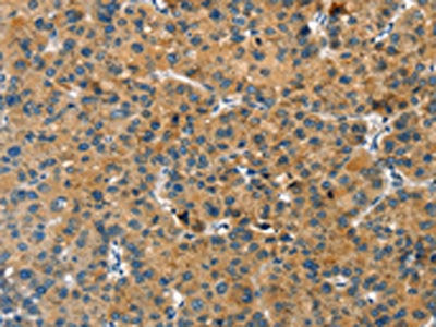 The image on the left is immunohistochemistry of paraffin-embedded Human liver cancer tissue using CSB-PA106951(GNB2L1 Antibody) at dilution 1/20, on the right is treated with fusion protein. (Original magnification: ×200)