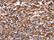 The image on the left is immunohistochemistry of paraffin-embedded Human thyroid cancer tissue using CSB-PA107052(IL1A Antibody) at dilution 1/40, on the right is treated with fusion protein. (Original magnification: ×200)