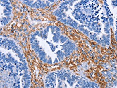 The image on the left is immunohistochemistry of paraffin-embedded Human ovarian cancer tissue using CSB-PA107067(PLK1 Antibody) at dilution 1/15, on the right is treated with fusion protein. (Original magnification: ×200)