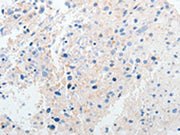 The image on the left is immunohistochemistry of paraffin-embedded Human ovarian cancer tissue using CSB-PA107290(PRMT5 Antibody) at dilution 1/50, on the right is treated with synthetic peptide. (Original magnification: ×200)