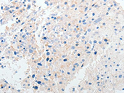 The image on the left is immunohistochemistry of paraffin-embedded Human ovarian cancer tissue using CSB-PA107290(PRMT5 Antibody) at dilution 1/50, on the right is treated with synthetic peptide. (Original magnification: ×200)