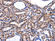 The image on the left is immunohistochemistry of paraffin-embedded Human thyroid cancer tissue using CSB-PA107393(FBN1 Antibody) at dilution 1/47, on the right is treated with synthetic peptide. (Original magnification: ×200)