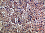 Immunohistochemical analysis of paraffin-embedded human-lung-cancer, antibody was diluted at 1:200