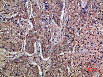 Immunohistochemical analysis of paraffin-embedded human-lung-cancer, antibody was diluted at 1:200