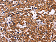 The image on the left is immunohistochemistry of paraffin-embedded Human thyroid cancer tissue using CSB-PA107776(MSH4 Antibody) at dilution 1/30, on the right is treated with fusion protein. (Original magnification: ×200)