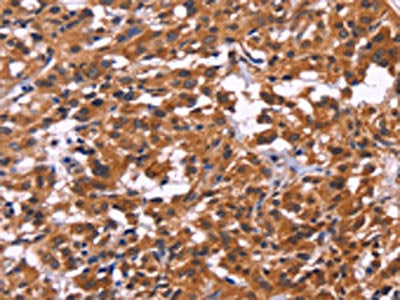 The image on the left is immunohistochemistry of paraffin-embedded Human thyroid cancer tissue using CSB-PA107776(MSH4 Antibody) at dilution 1/30, on the right is treated with fusion protein. (Original magnification: ×200)