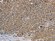 The image on the left is immunohistochemistry of paraffin-embedded Human ovarian cancer tissue using CSB-PA107998(NDUFS7 Antibody) at dilution 1/40, on the right is treated with fusion protein. (Original magnification: ×200)