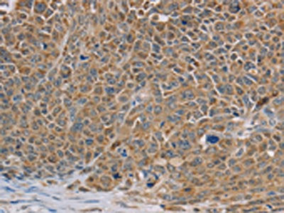 The image on the left is immunohistochemistry of paraffin-embedded Human ovarian cancer tissue using CSB-PA107998(NDUFS7 Antibody) at dilution 1/40, on the right is treated with fusion protein. (Original magnification: ×200)