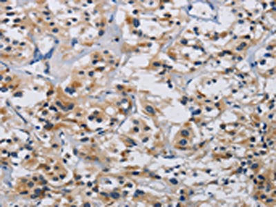 The image on the left is immunohistochemistry of paraffin-embedded Human thyroid cancer tissue using CSB-PA108283(ITGA11 Antibody) at dilution 1/20, on the right is treated with synthetic peptide. (Original magnification: ×200)