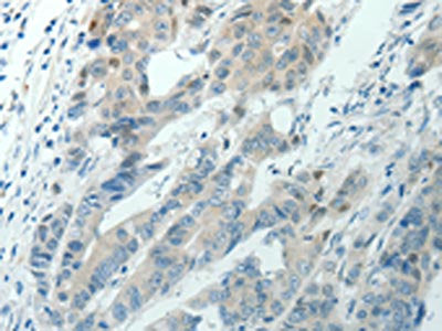 The image on the left is immunohistochemistry of paraffin-embedded Human colon cancer tissue using CSB-PA108298(RNF126 Antibody) at dilution 1/70, on the right is treated with synthetic peptide. (Original magnification: ×200)