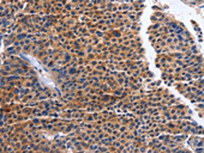 The image on the left is immunohistochemistry of paraffin-embedded Human liver cancer tissue using CSB-PA108299(MAP3K13 Antibody) at dilution 1/20, on the right is treated with fusion protein. (Original magnification: ×200)