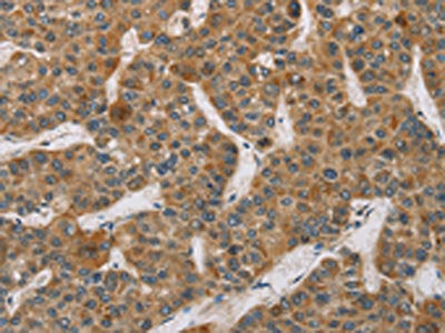 The image on the left is immunohistochemistry of paraffin-embedded Human liver cancer tissue using CSB-PA108423(DCTN2 Antibody) at dilution 1/50, on the right is treated with fusion protein. (Original magnification: ×200)