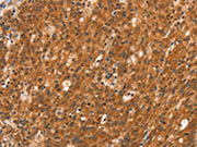 The image on the left is immunohistochemistry of paraffin-embedded Human gastic cancer tissue using CSB-PA108593(DAB2IP Antibody) at dilution 1/40, on the right is treated with synthetic peptide. (Original magnification: X200)