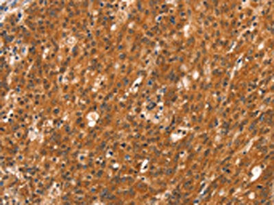 The image on the left is immunohistochemistry of paraffin-embedded Human gastic cancer tissue using CSB-PA108593(DAB2IP Antibody) at dilution 1/40, on the right is treated with synthetic peptide. (Original magnification: X200)